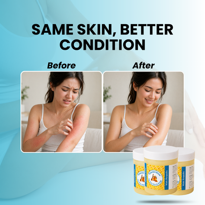 Steriod Free Balm For Eczema & Psoriasis