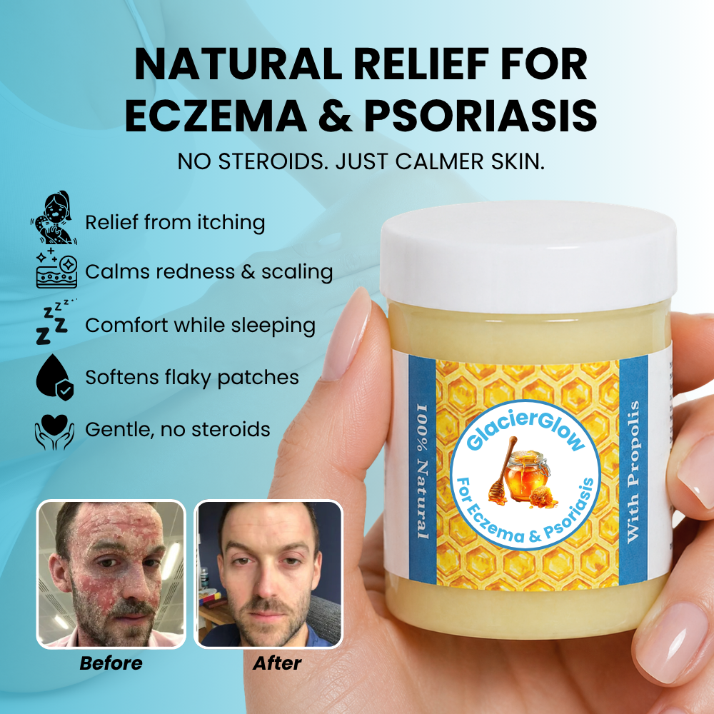 Steriod Free Balm For Eczema & Psoriasis